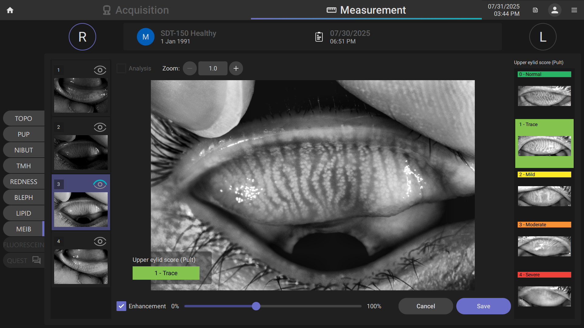 TERA scan revealing the oil-producing glands inside an eyelid